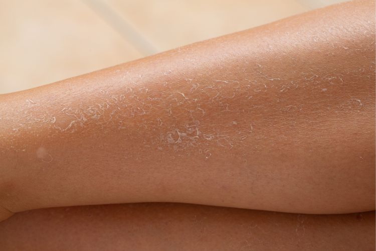 dry skin on legs